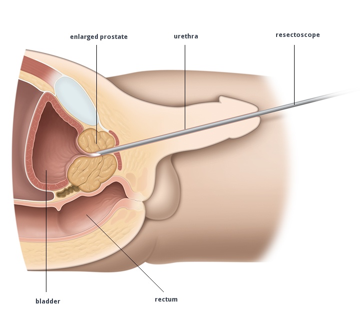 Introducing Penis Plugs