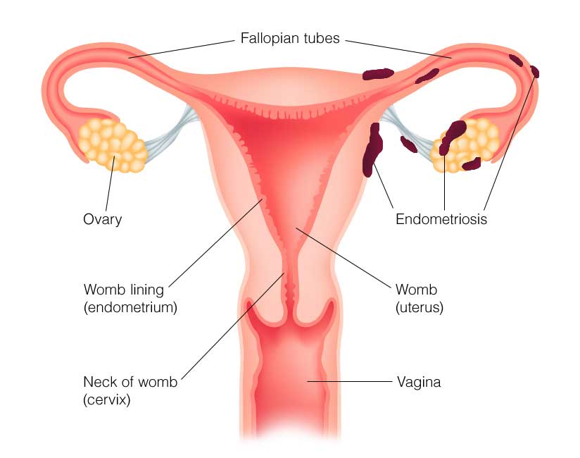 Endometriosis