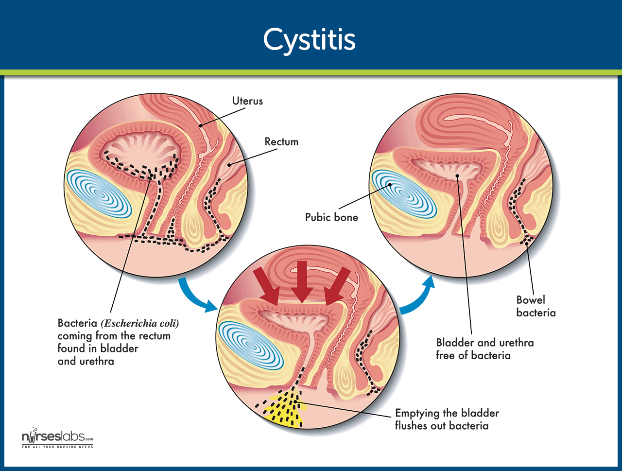 urinary tract infection